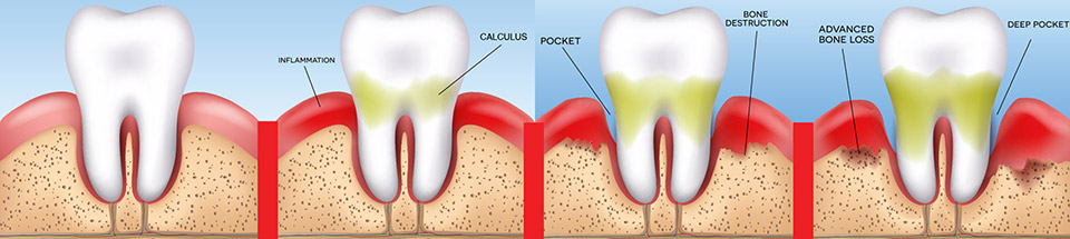 laser gum surgery fort worth dentist