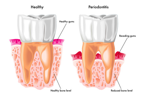 laser gum surgery fort worth dentist