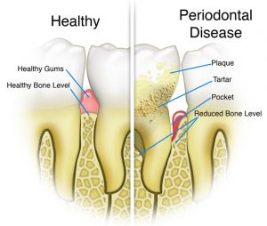 laser gum surgery fort worth dentist